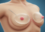 All you need to know about breast augmentation breast augmentation