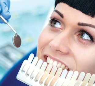 Teeth whitening