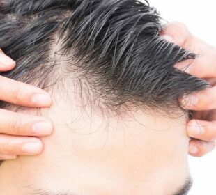 Hair Loss