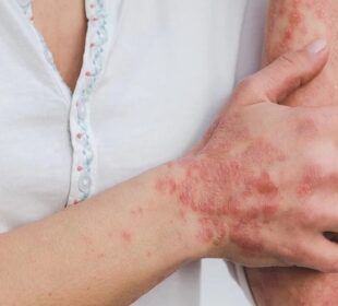 Psoriasis