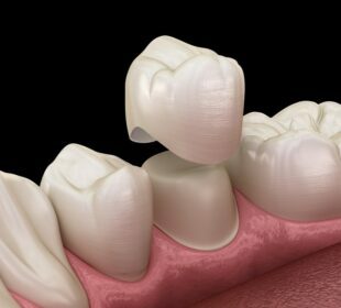 Dental Crowns