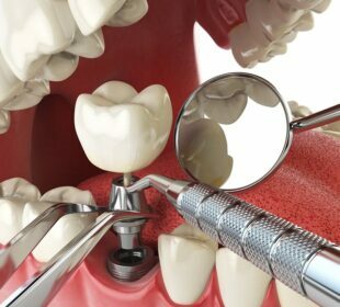 Dental Implant Surgery