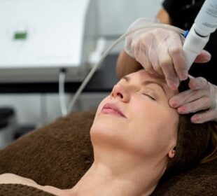 Laser Resurfacing