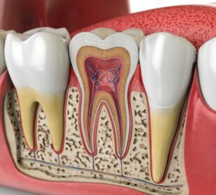 root canal treatment
