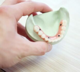Tooth Implant
