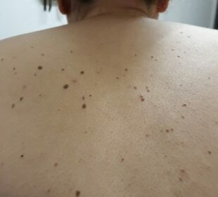 All You Need To Know About Seborrheic Keratosis seborrheic keratosis