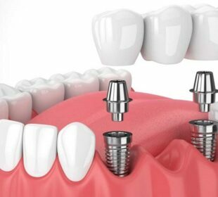 Dental Implants