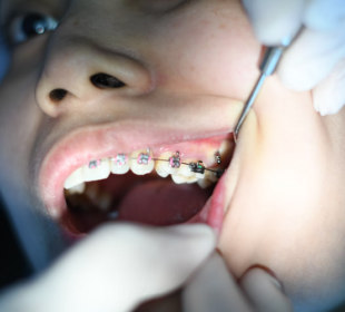 Braces Fix