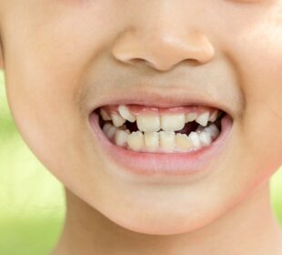 Crooked Teeth