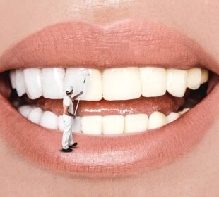 Teeth Whitener